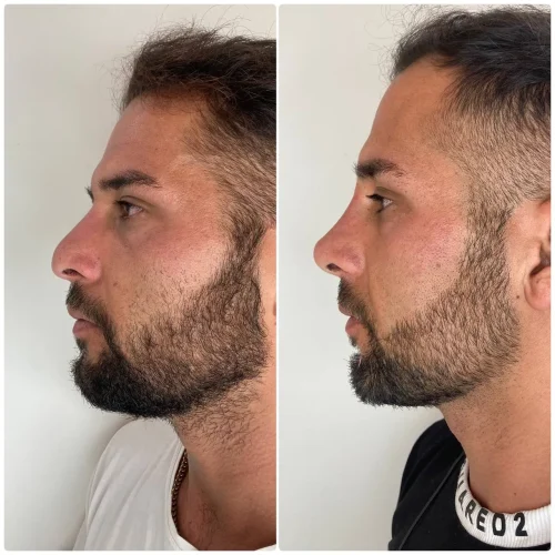نمونه کار لیفت بینی1