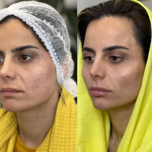 جوانسازی و لیفت (3)