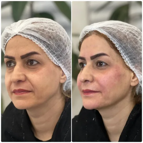 جوانسازی و لیفت (4)
