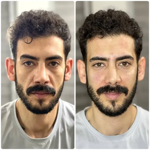 جوانسازی و لیفت